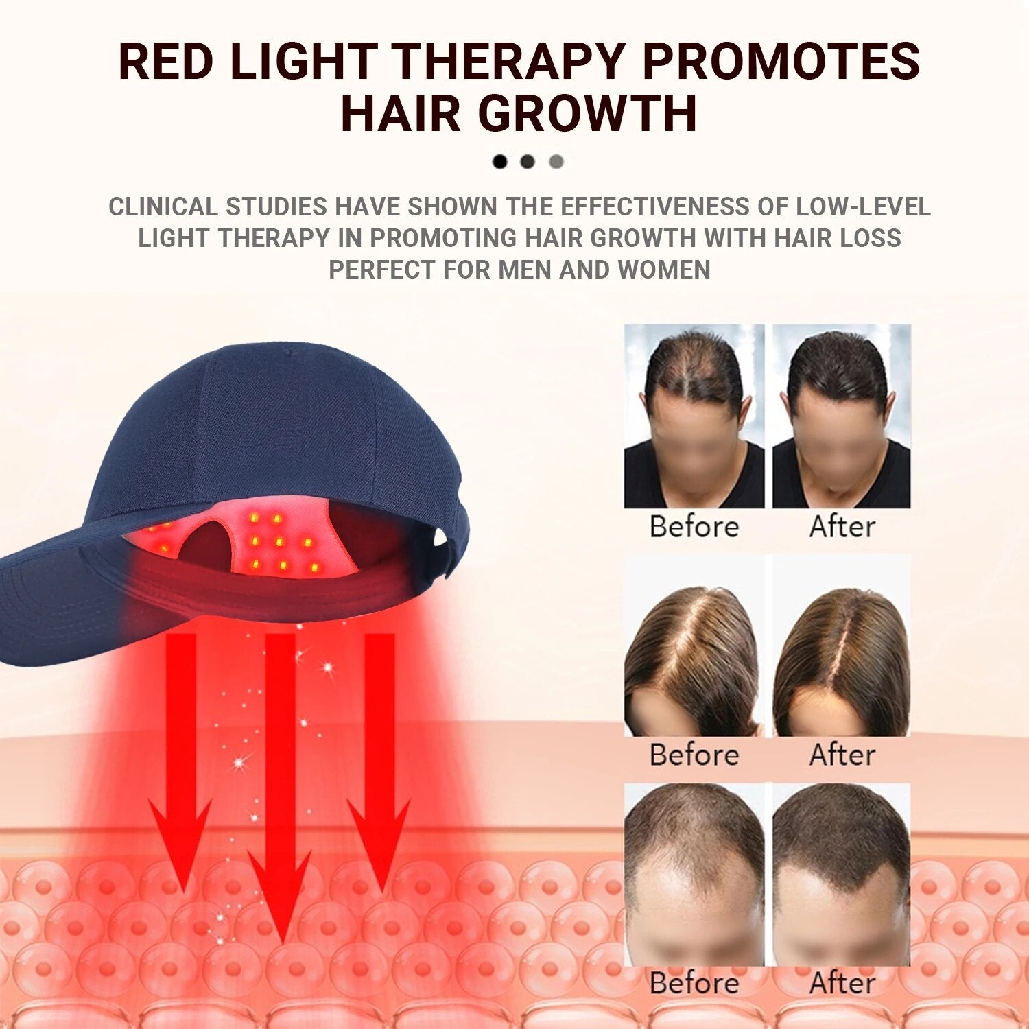 Red Light Therapy Outperforms Hair Growth Drugs Without Side Effects  Introduction